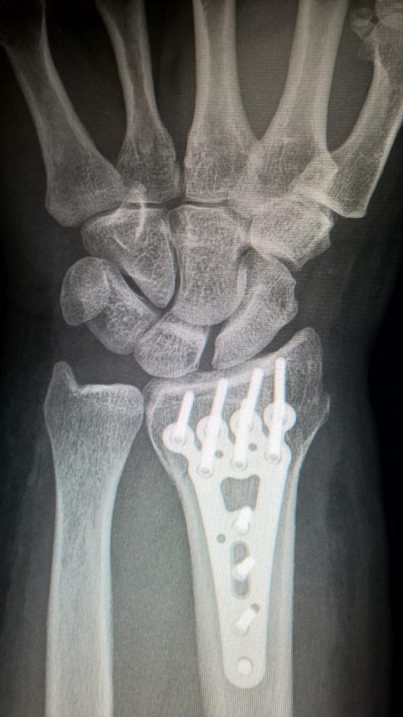 La osteogénesis por distracción ósea es un procedimiento de reconstrucción en el que se utiliza un elemento externo denominado distractor que separa gradualmente el hueso.